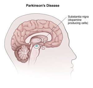 parkinsons disease symptoms causes and homeopathic